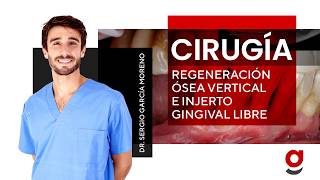 🔴CIRUGÍA🦷Regeneración ósea vertical con aloinjerto y membrana de PTFE e injerto gingival libre [upl. by Alyehc473]