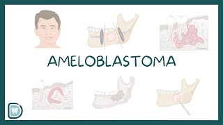 Understanding Ameloblastoma Causes Diagnosis Types and Treatment [upl. by Cesaro200]