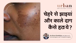 चेहरे से झाइयां और काले दाग कैसे हटाये  Melasma in Hindi कारण निवारण उपाय  Urban Skin amp Hair [upl. by Arelc14]