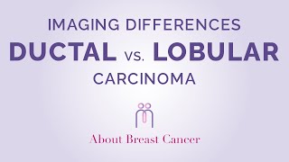 Imaging Differences between Ductal and Lobular Carcinoma [upl. by Costa]