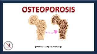 OSTEOPOROSIS  Causes  Pathophysiology  Treatment  Nursing Management  The Nurses Station [upl. by Wooster687]