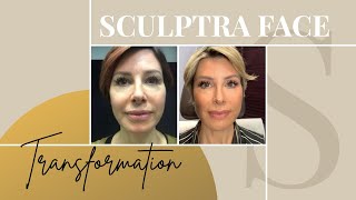 Sculptra Before amp After  My Review on the NonSurgical Facelift  Dominique Sachse [upl. by Kurland982]