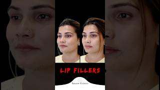 Lip Enhancement Transformation Before amp After  Sarayu Clinics fillers [upl. by Galliett]