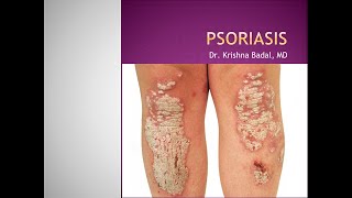 Psoriasis [upl. by Pliner]