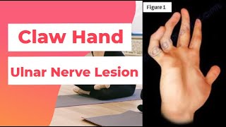 Claw Hand  Ulnar Nerve Lesion  PhysiotherapyKnowledge [upl. by Uno]