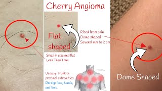 Cherry angioma  Red moles on skin [upl. by Ax]