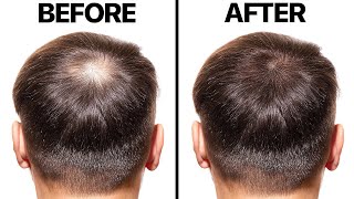 Minoxidil for Hair Loss [upl. by Eetnom]