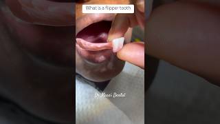 What is a flipper tooth Missing teeth [upl. by Ettennal465]