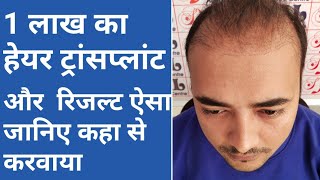 best hair transplant results in india  best hair transplant cost in india [upl. by Sacrod]