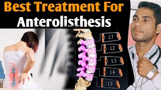 anterolisthesis l5 s1 treatment Spondylolisthesis grade 1 treatment exercises grade 2 l4 L5 Hindi [upl. by Ecinaej]