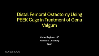 Distal Femoral Osteotomy Using PEEK Cage in Treatment of Genu Valgum [upl. by Korwun8]