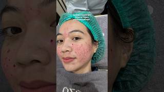 kombinasi treatment bopeng  Subcision combine Rejuran scars SozoSkinClinic [upl. by Ecyob]