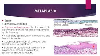 Disorders of growth and neoplasia  metaplasia dysplasia and carcinoma in situ [upl. by Minetta]