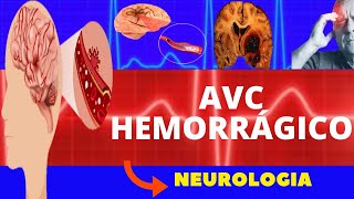 ACIDENTE VASCULAR CEREBRAL HEMORRÁGICO CAUSAS SINTOMAS DIAGNÓSTICO E TRATAMENTO AVC HEMORRÁGICO [upl. by Enelam]