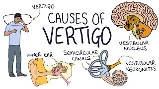 Understanding the Causes of Vertigo [upl. by Zaller]