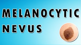 Melanocytic Nevus Symptoms Treatment and Causes [upl. by Donella399]