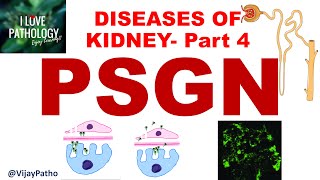 RENAL PATHOLOGY Part 4 Acute Post Streptococcal Glomerulonephritis Pathogenesis amp Morphology [upl. by Allyson]