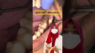 അപകടം കണ്ടില്ലേ😱dentist malayalam youtubeshorts viral trending shorts [upl. by Erdried410]