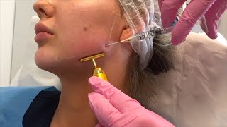 Jawline Filler London  by Dr Leah Totton [upl. by Sacci]