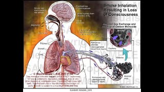 Inhalational Injuries  Causes  Treatment  Management [upl. by Esinel]