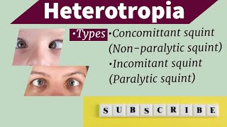 heterotropia part1 Concomitant squintEsotropiaExotropia Nonparalytic squint [upl. by Ramburt]