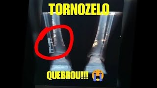 TORNOZELO QUEBRADO CIRURGIA E RECUPERAÇÃO POS CIRURGIA [upl. by Marya]