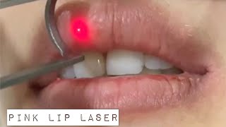 Lip Lightening Laser Treatment [upl. by Annissa]