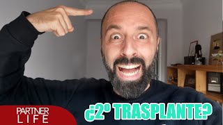 ¿2º TRASPLANTE DE PELO [upl. by Aicram]