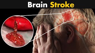 What Happens In Brain Stroke  Ischemic And Hemorrhagic Stroke [upl. by Suravart582]