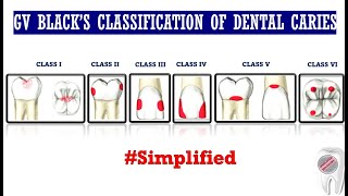 GV Blacks Classification of Dental Caries [upl. by Maximilianus]