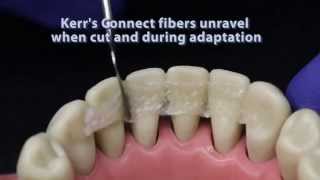 Ribbond compared to other dental fiber reinforcement materials [upl. by Eriha903]