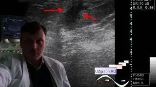 Breast ultrasound  Birads 0 by mammography vs birads 45 by ultrasound [upl. by Nyrol391]