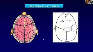 EANS Webinar Childhoodonset craniopharyngioma [upl. by Telrahc387]