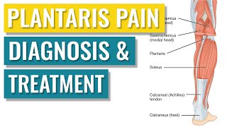 Plantaris Tendonitis  Symptoms and Treatment [upl. by Ecissej]