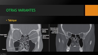 Anatomía y patología de los senos paranasales Dr Franklin O Ordoñez [upl. by Nadabas]