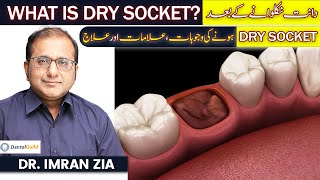 Dry Socket After Tooth Extraction  Causes Symptoms amp Treatment  Dr Imran Zia  Dental Guild [upl. by Hannala]