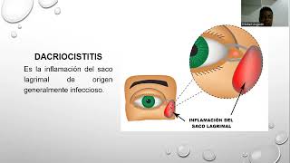 Dacrioadenitis y dacriocistitis [upl. by Leiram]