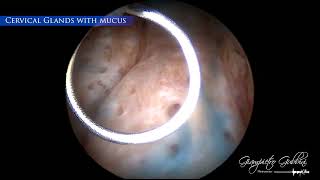 Clinical case Endocervical Ablation with GUBBINI MiniHysteroResectoscope by Dr Gubbini [upl. by Cummings767]