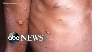 The symptoms treatment for monkeypox l ABC News [upl. by Nnylarak]