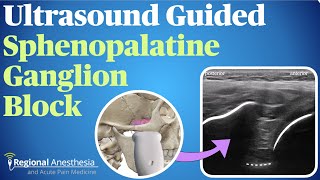 Ultrasound Guided Sphenopalatine Ganglion Block [upl. by Sonia]