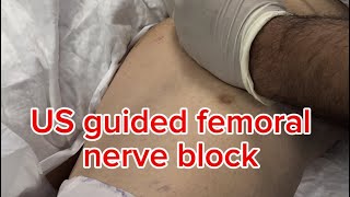 Us guided femoral nerve block [upl. by Leola]