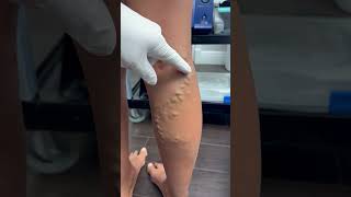 How Do You Treat Bulging Varicose Veins [upl. by Elbert10]