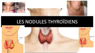 nodule thyroïdienne  part 1 [upl. by Yenahteb]