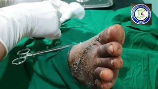 Dorsum Foot injury  Accidental axe injury foot  Kwire removal foot  Adamya Hosp videos [upl. by Friederike]