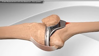 Knee Replacement with the iBalance TKA System [upl. by Yelir70]