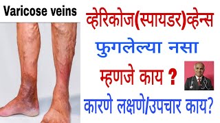 Varicose veinsव्हेरिकोजस्पायडरव्हेन्स म्हणजे कायकारणे लक्षणे व उपचार काय1388drramjawale [upl. by Udall]