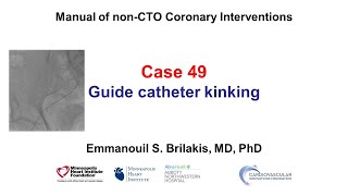 Case 49 PCI Manual  Guide catheter kinking [upl. by Hunfredo]