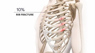 Management of Acute and Chronic Rib Fractures [upl. by Attenauq]