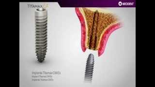 Implante Neodent  Titamax EX [upl. by Carbone]