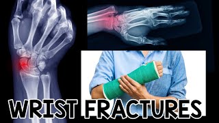 Understanding Wrist Fractures Causes Treatments amp Essential Protective Gear for HighImpact Sports [upl. by Hazrit]